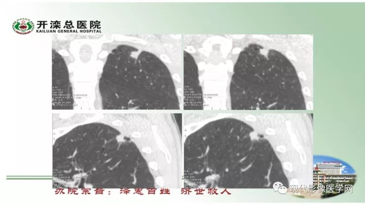 【病例】肺部结节病6例读片