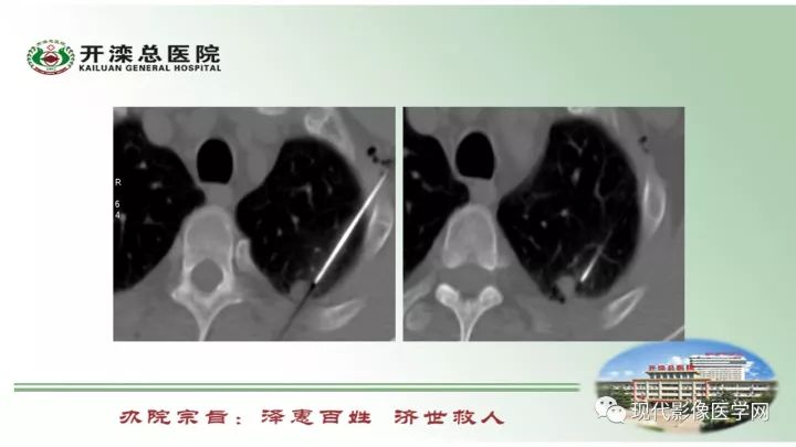 【病例】肺部结节病6例读片