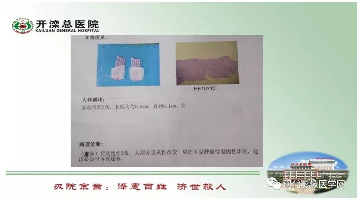 【病例】肺部结节病6例读片