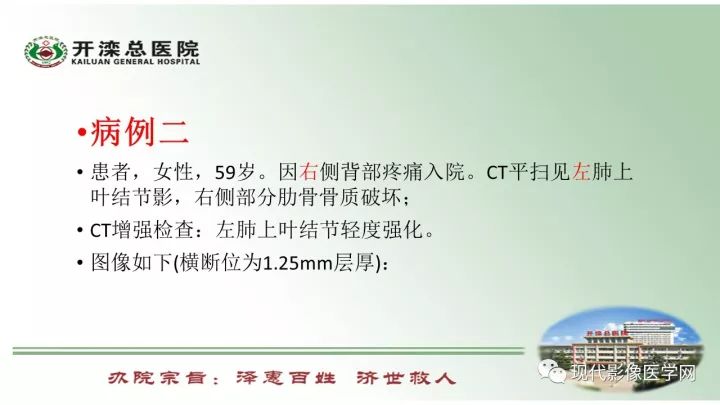 【病例】肺部结节病6例读片