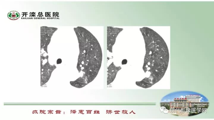 【病例】肺部结节病6例读片