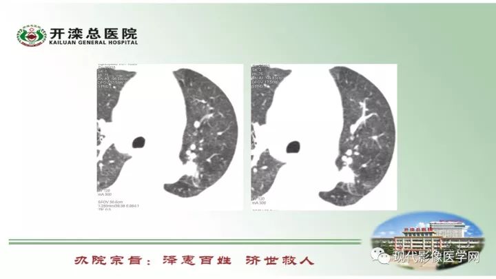 【病例】肺部结节病6例读片