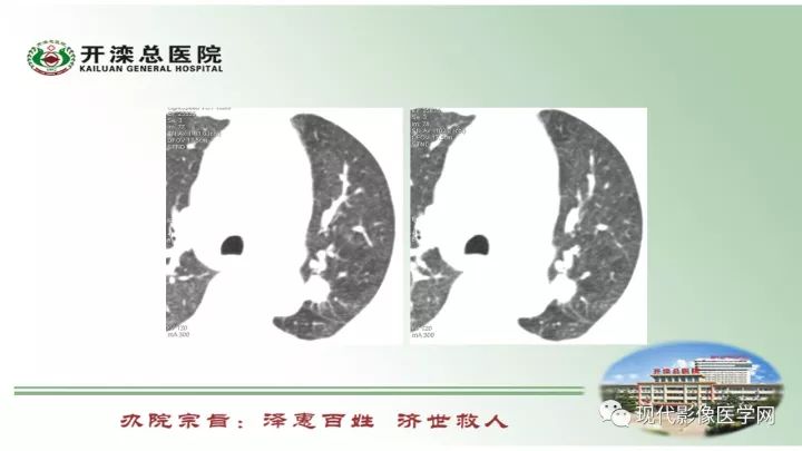 【病例】肺部结节病6例读片