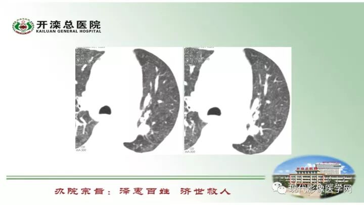 【病例】肺部结节病6例读片