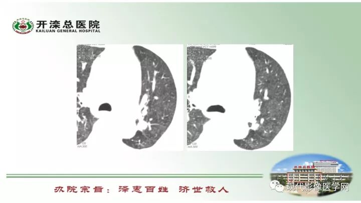 【病例】肺部结节病6例读片
