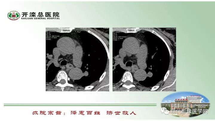 【病例】肺部结节病6例读片