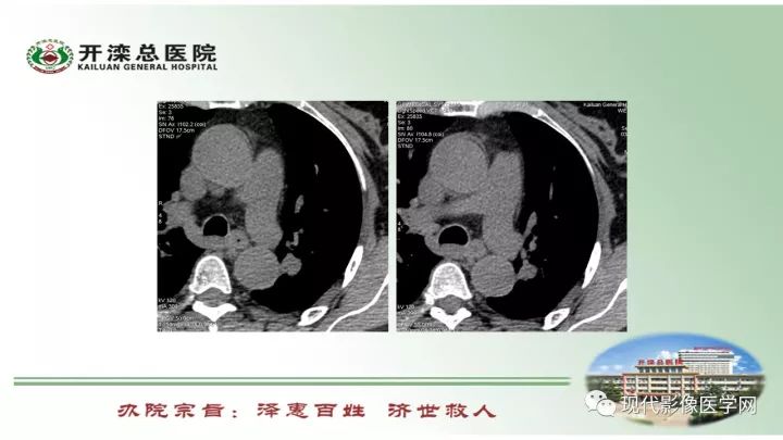 【病例】肺部结节病6例读片