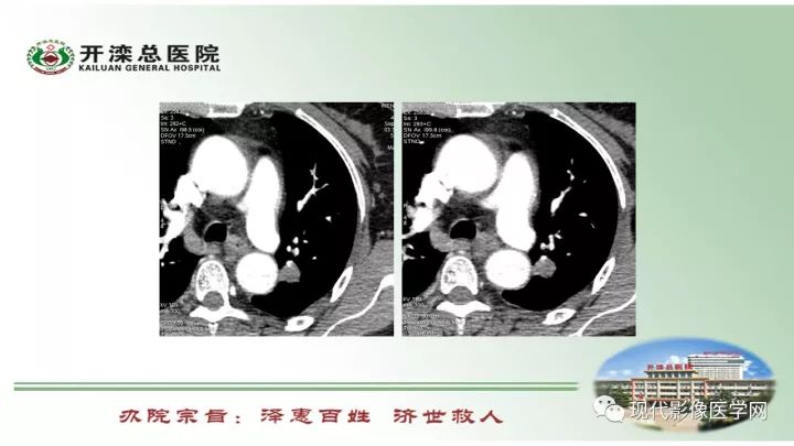【病例】肺部结节病6例读片