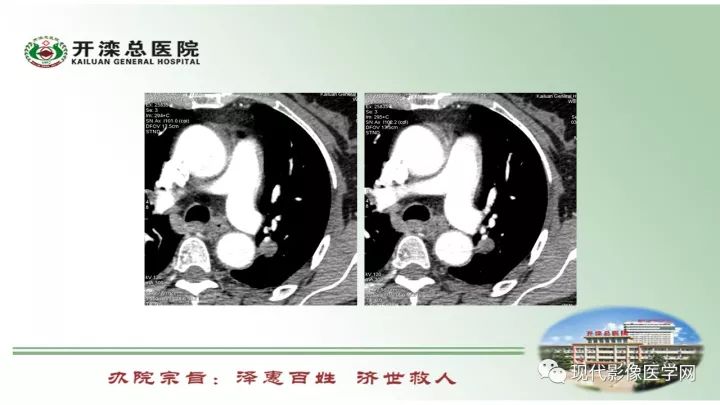 【病例】肺部结节病6例读片