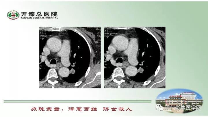 【病例】肺部结节病6例读片