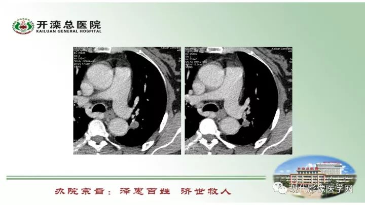 【病例】肺部结节病6例读片