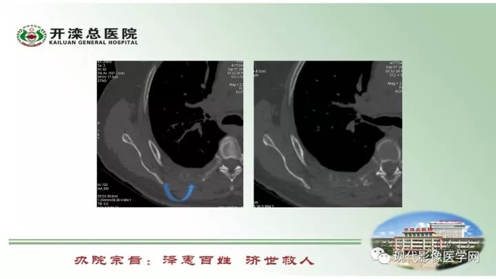 【病例】肺部结节病6例读片