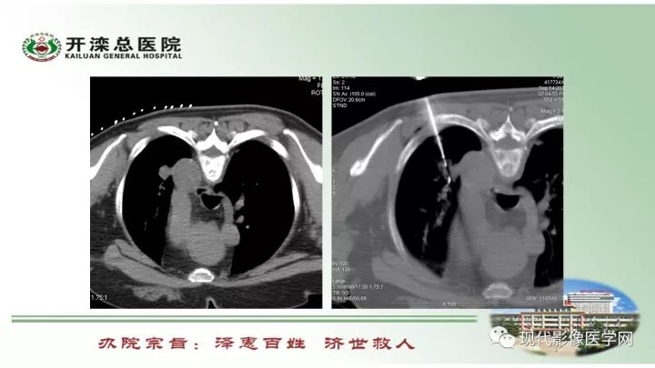 【病例】肺部结节病6例读片