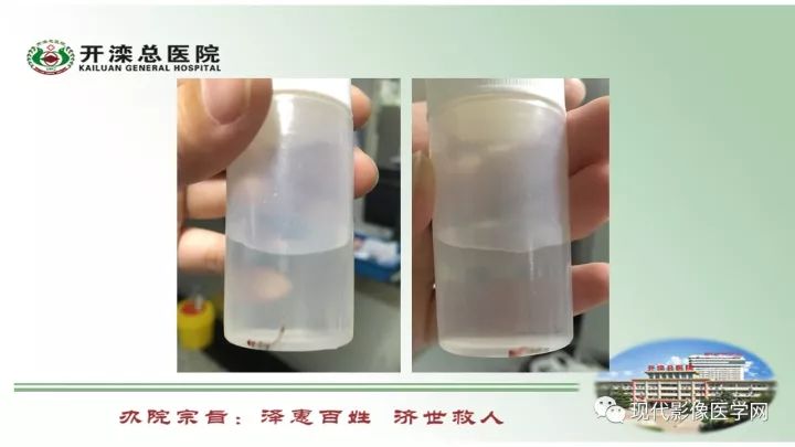 【病例】肺部结节病6例读片