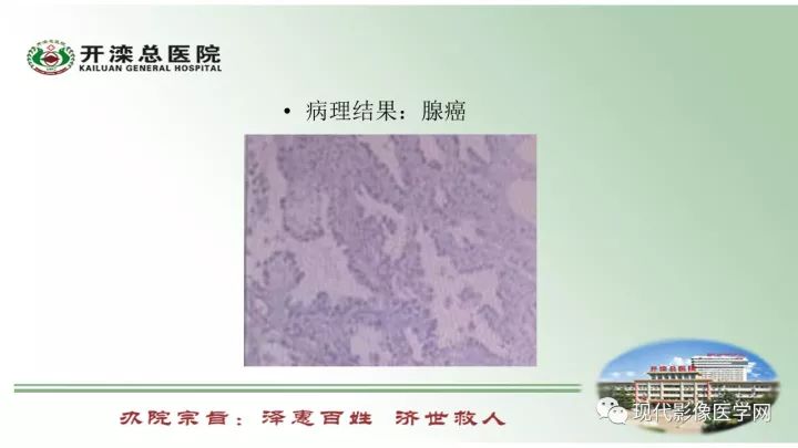 【病例】肺部结节病6例读片