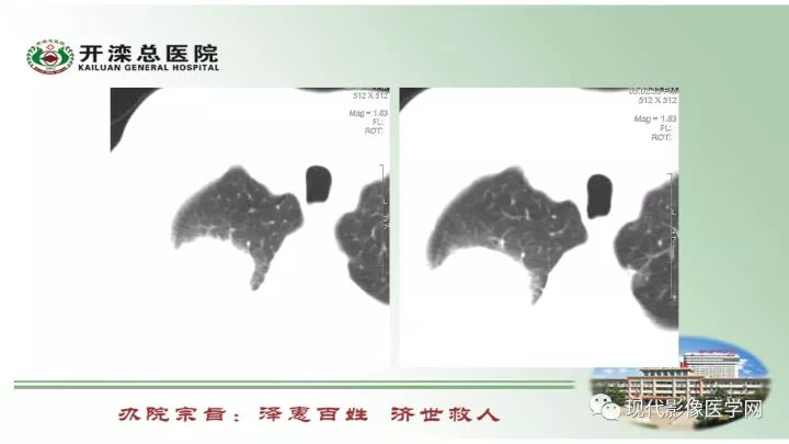 【病例】肺部结节病6例读片