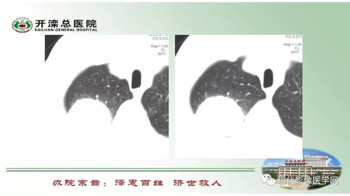 【病例】肺部结节病6例读片