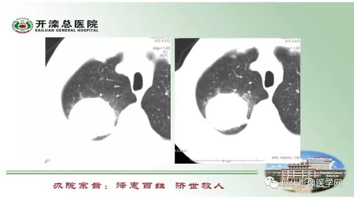 【病例】肺部结节病6例读片