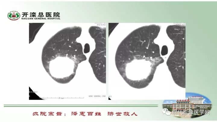 【病例】肺部结节病6例读片