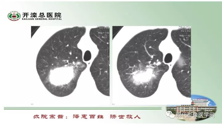 【病例】肺部结节病6例读片