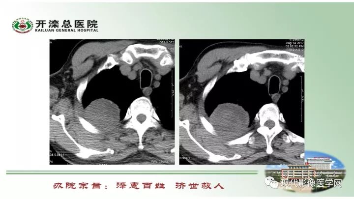 【病例】肺部结节病6例读片