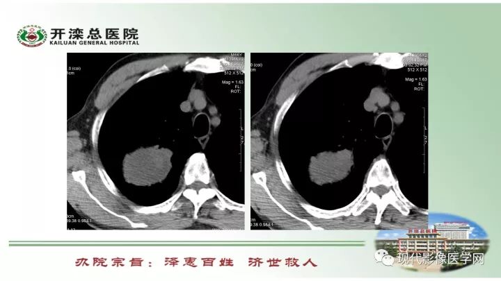 【病例】肺部结节病6例读片
