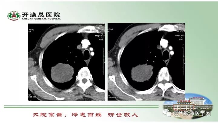 【病例】肺部结节病6例读片