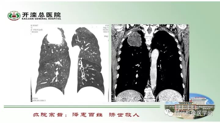 【病例】肺部结节病6例读片