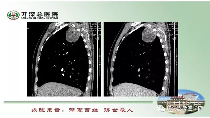 【病例】肺部结节病6例读片