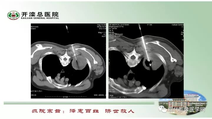 【病例】肺部结节病6例读片