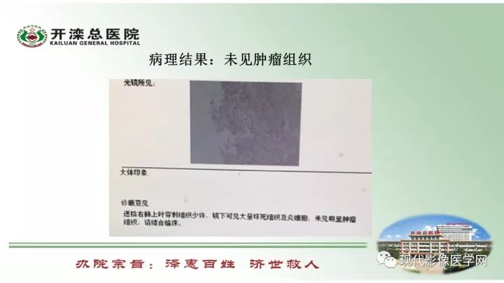 【病例】肺部结节病6例读片