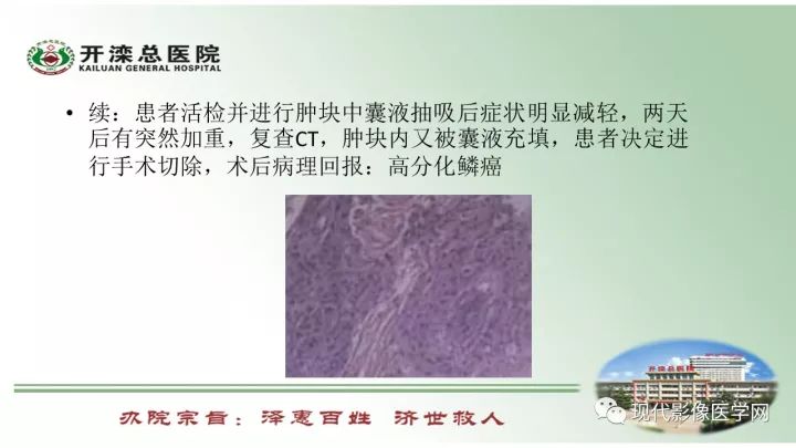 【病例】肺部结节病6例读片