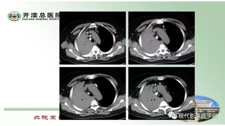 【病例】肺部结节病6例读片