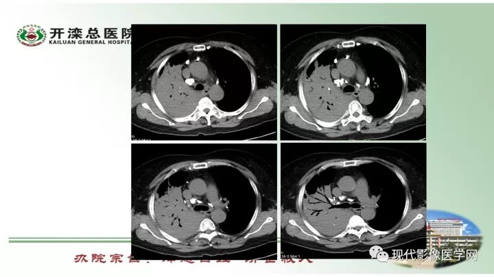 【病例】肺部结节病6例读片