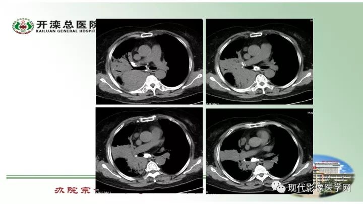 【病例】肺部结节病6例读片