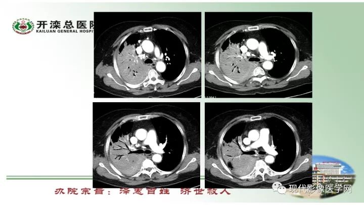 【病例】肺部结节病6例读片