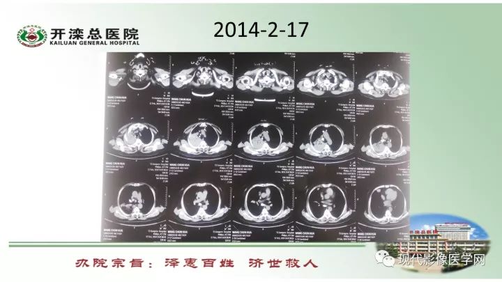 【病例】肺部结节病6例读片