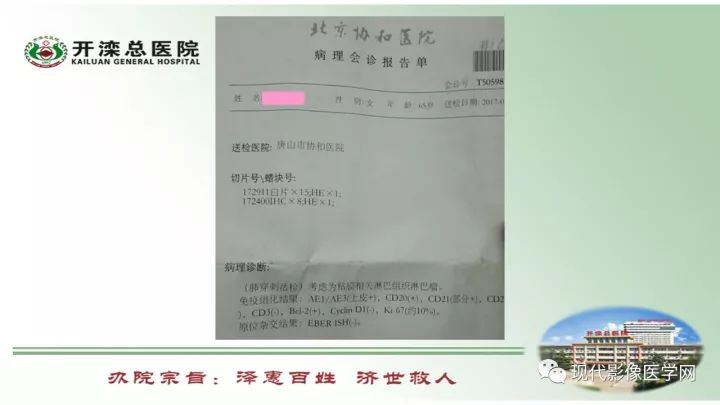 【病例】肺部结节病6例读片