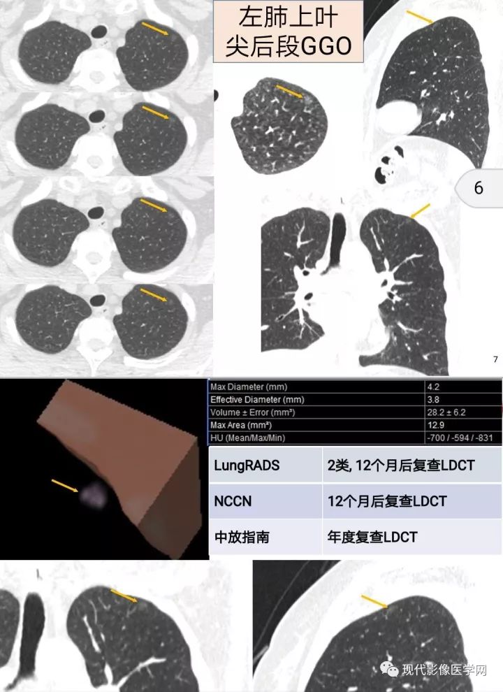 【病例】肺部结节病6例读片