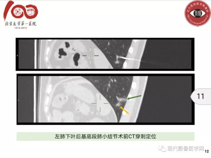 【病例】肺部结节病6例读片