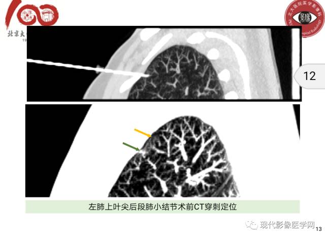 【病例】肺部结节病6例读片