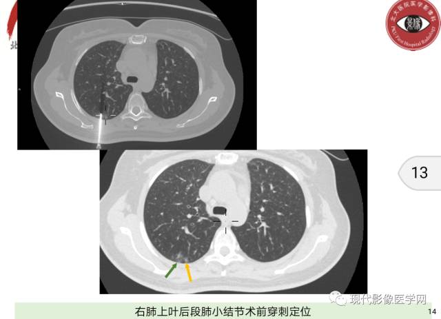 【病例】肺部结节病6例读片