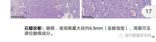 【病例】肺部结节病6例读片