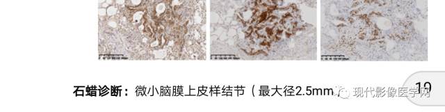 【病例】肺部结节病6例读片