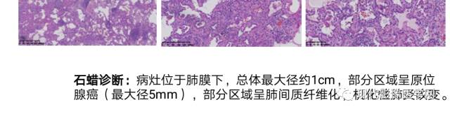 【病例】肺部结节病6例读片