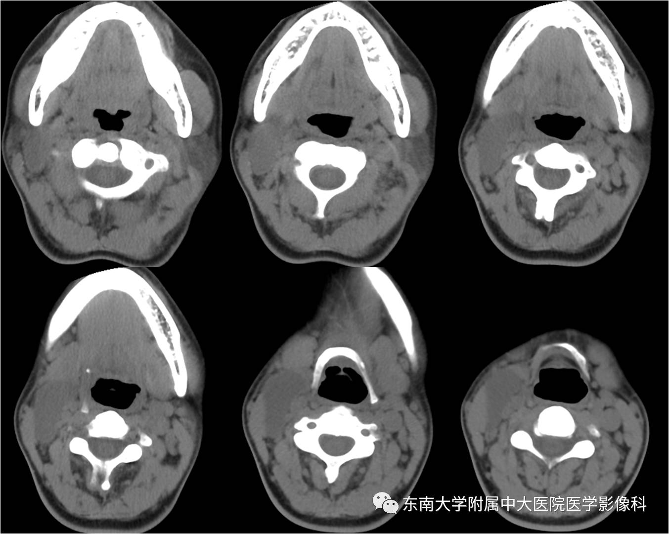 【病例】鳃裂囊肿VS甲状舌管囊肿1例CT