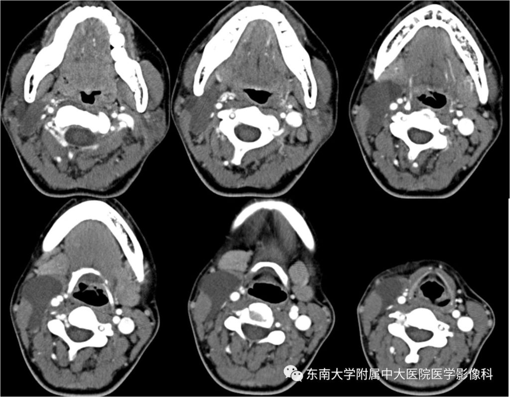 【病例】鳃裂囊肿VS甲状舌管囊肿1例CT