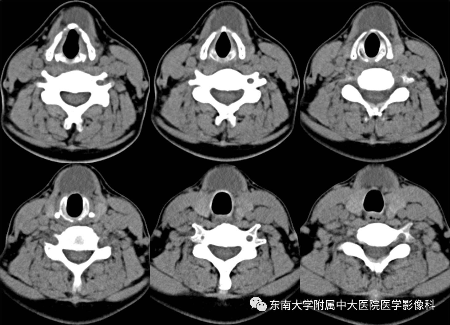 【病例】鳃裂囊肿VS甲状舌管囊肿1例CT