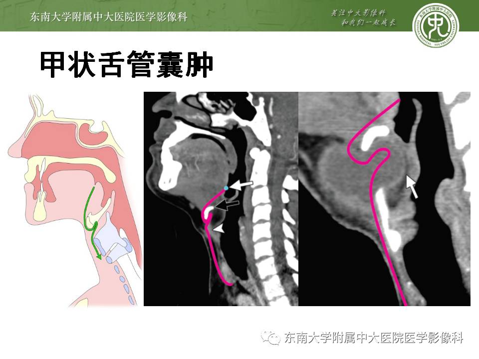 【病例】鳃裂囊肿VS甲状舌管囊肿1例CT