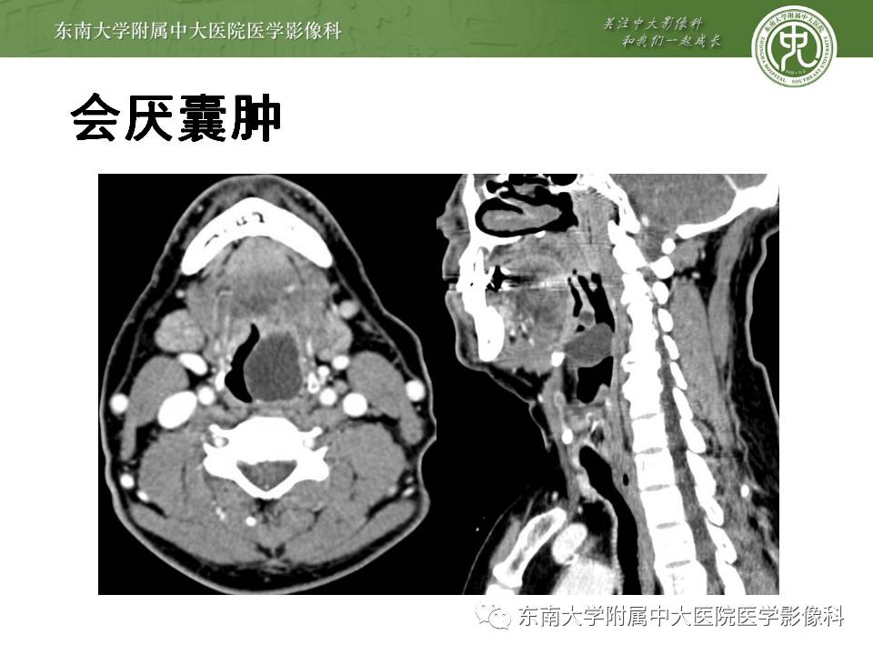 【病例】鳃裂囊肿VS甲状舌管囊肿1例CT